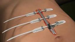 Non-invasive Surgical Wound Closure Market undergoing digital transformation through remote monitoring and diagnostics tools