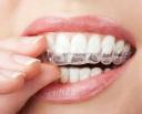 Orthodontic Retainers Market insights reveal shift toward patient-friendly and sustainable dental products