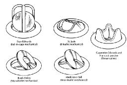 Prosthetic Heart Valves Market Insights Show Rapid Shift Toward Transcatheter and Minimally Invasive Procedures