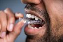 Orthodontic Retainers Market Sees Growth Due to Rising Orthodontic Cases Among Adolescents
