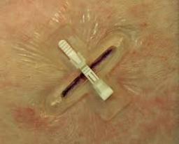 Non-invasive Surgical Wound Closure Market latest R&D developments driving future market breakthroughs