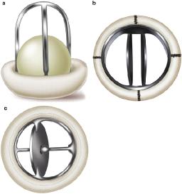 Prosthetic Heart Valves Market Trends: What Investors and Stakeholders Should Watch