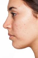 Anti-Acne Dermal Patch Market Strategies: Innovations Fueling Growth and Competitive Advantage Worldwide