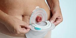 Technological Innovations to Transform the Landscape of the Ostomy Devices Market