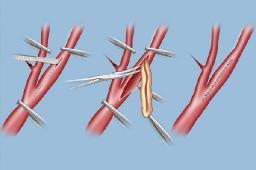 Vascular Patches Market Outlook Driven by Cardiovascular Disease Rise and Surgical Advancements Worldwide