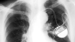 Cardiac Pacemaker Market Winning Strategies Balancing Technological Advancements with Patient-Centric Solutions